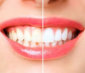 הלבנת שיניים